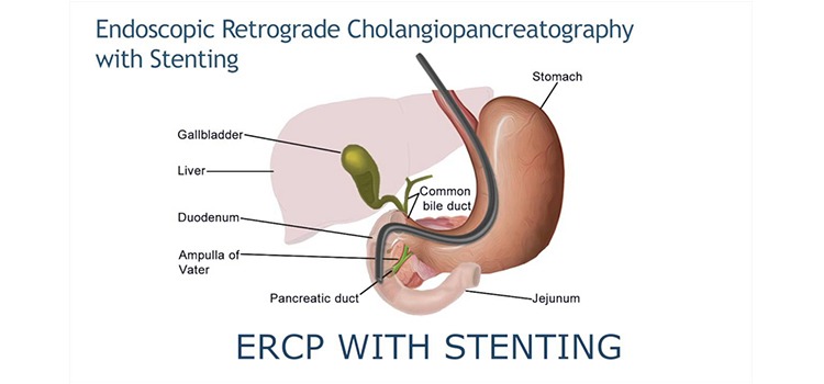 Endoscopic Retrograde Cholangiopancreatography (ERCP)